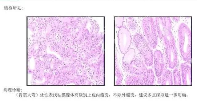 体检一切正常，一月后竟查出胃癌——没有胃肠镜的体检，都是耍流氓！